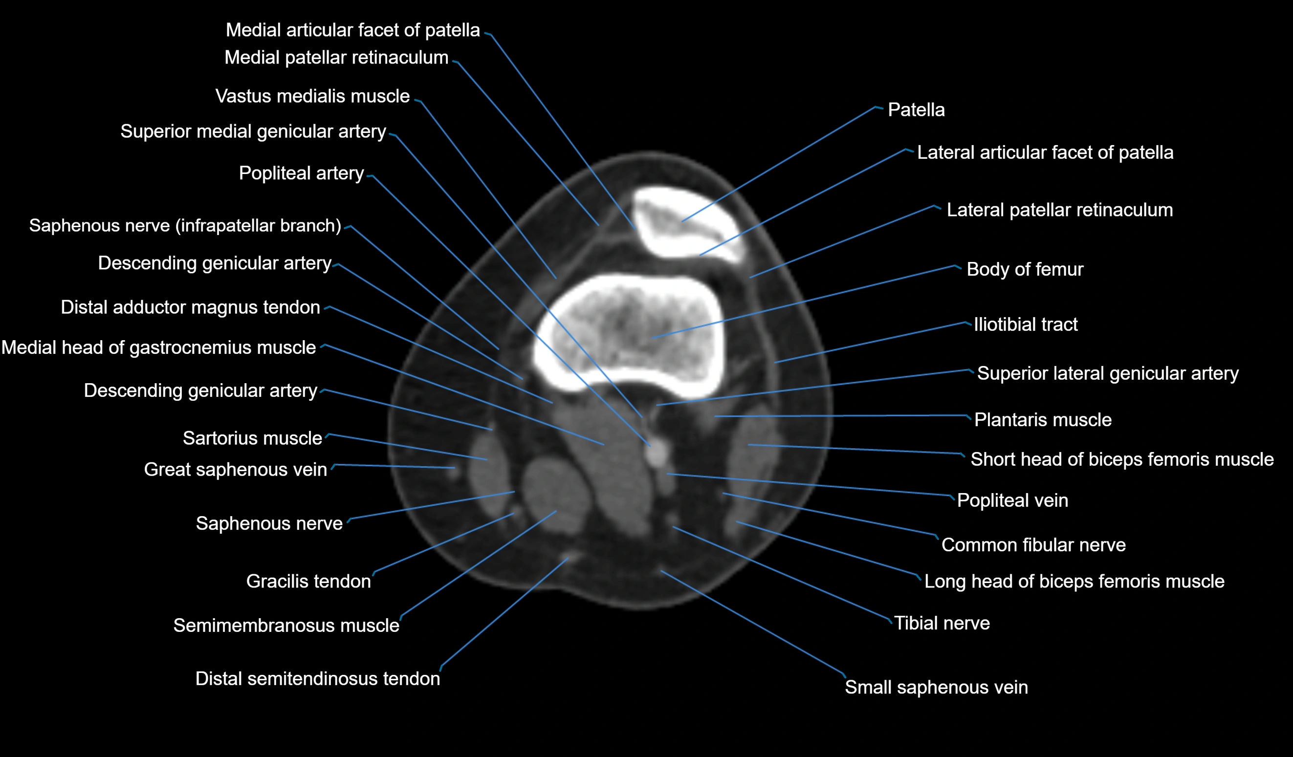 CT knee axial cross sectional anatomy labelled image-00021.webp